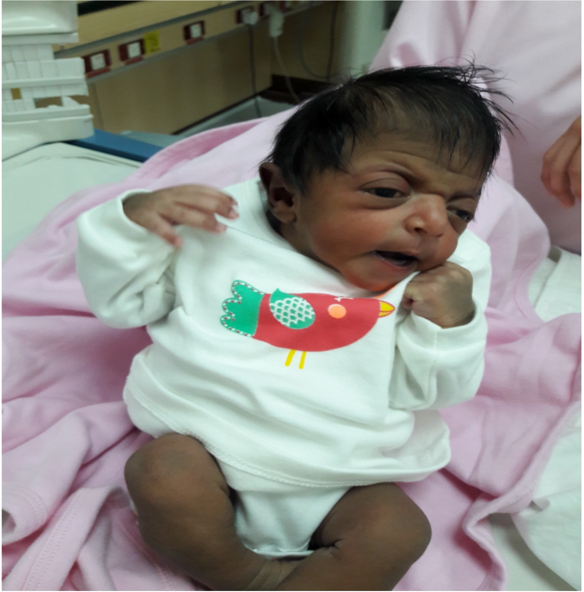 Craniosynostosis: A Case of Brachycephaly and Suspected Crouzon Syndrome in a Newborn